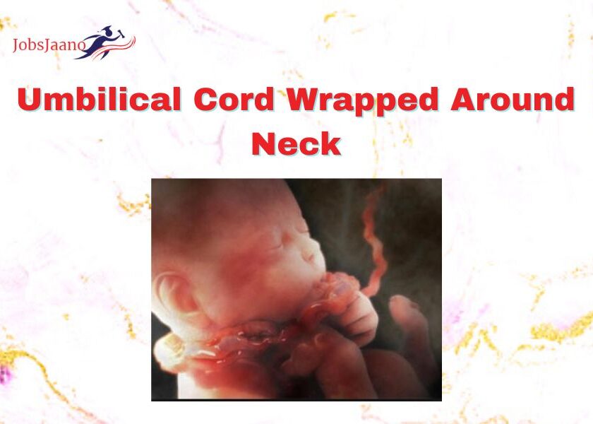 Umbilical Cord Wrapped Around Neck