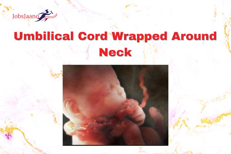 Umbilical Cord Wrapped Around Neck